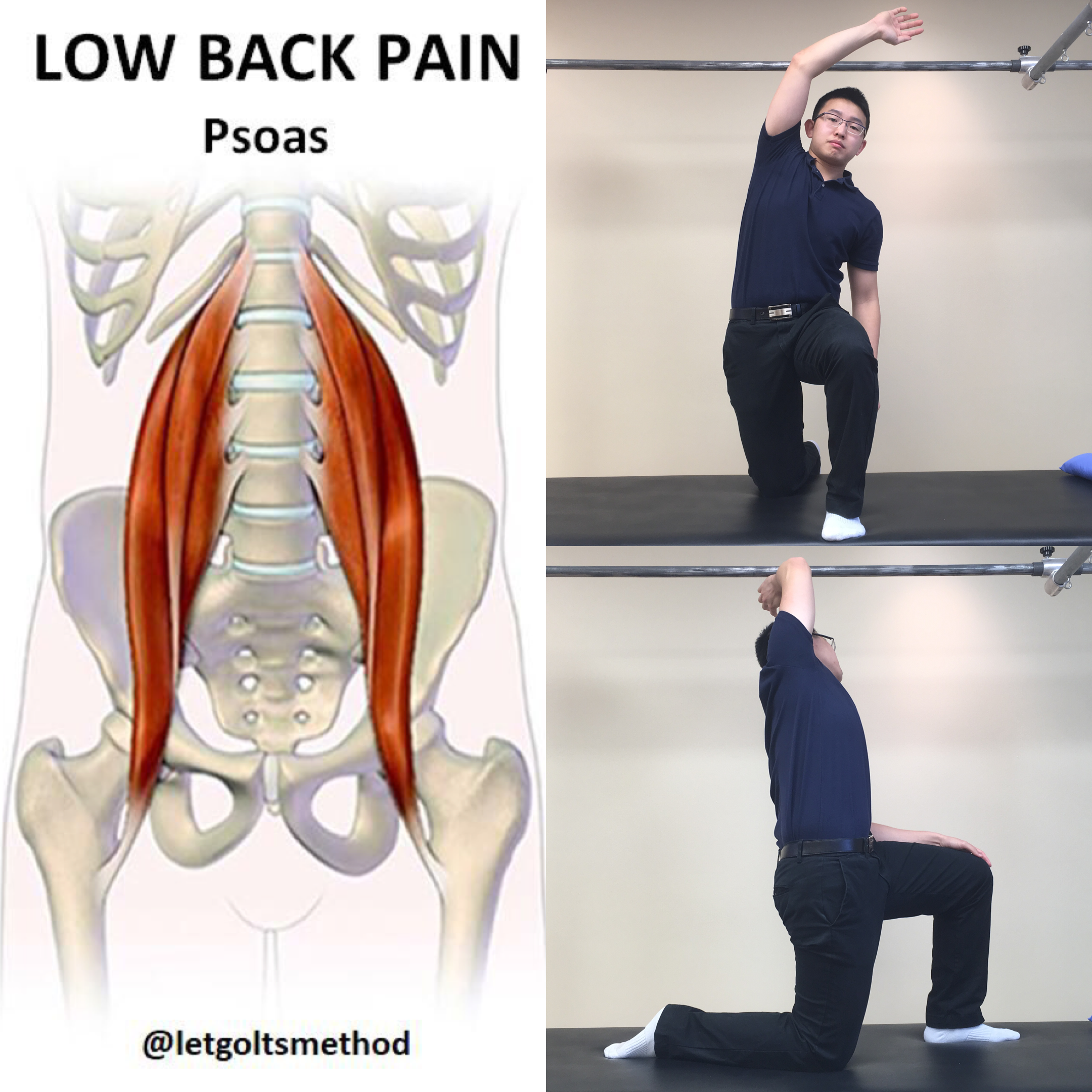 The Role of the Psoas Muscle in Lower Back Pain